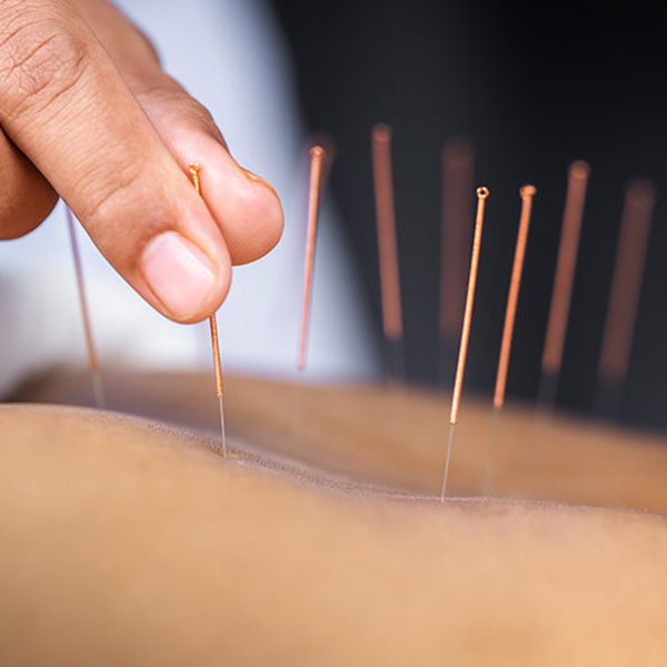 Traditional Acupuncture Treatment Chennai